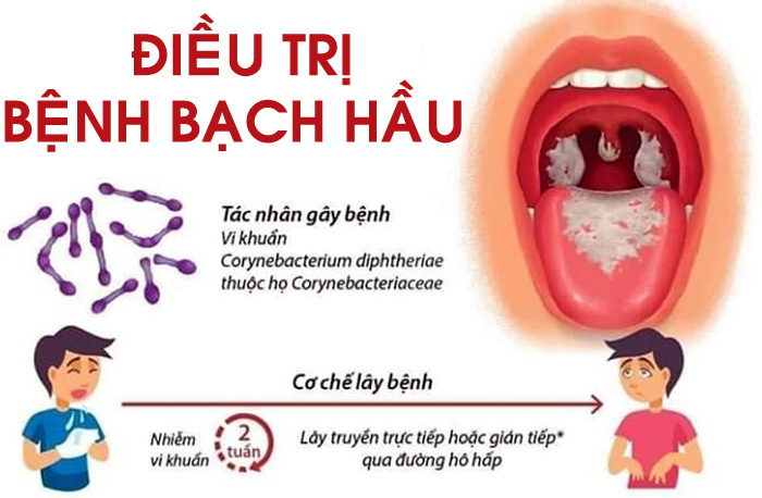 Điều trị bệnh Bạch Hầu bằng kháng sinh